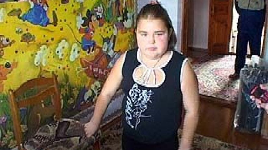 Врачи боролись за жизнь 11-летней девочки три года