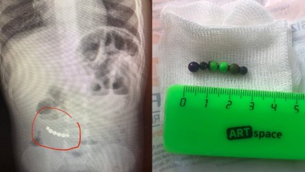 В Воронеже врачи достали из кишечника ребёнка 6 магнитов от конструктора 