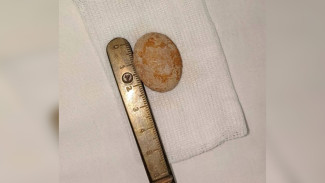 В Воронеже врачи вытащили 3-сантиметровый камень из мочевого пузыря 1,5-годовалого малыша 