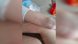 В Воронеже бездомная собака напала на девочку