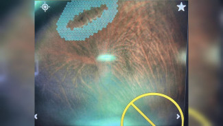 Воронежские врачи спасли зрение 16-летнему профессиональному спортсмену