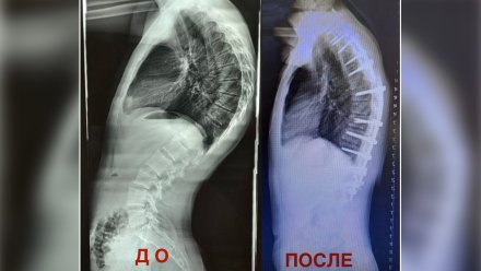В Воронеже нейрохирурги провели операцию 17-летнему парню с искривлённым позвоночником