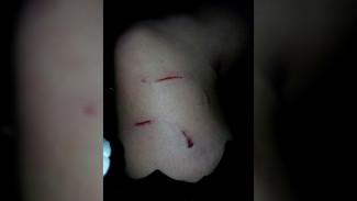 «Было много крови». В центре Воронежа на 18-летнюю хоккеистку набросилась собака 