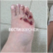 Жительница Воронежа получила перелом ноги после наезда велосипедиста