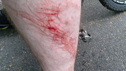 Пострадавший от укуса собаки с биркой воронежский велосипедист: «Сделали сразу 3 укола»
