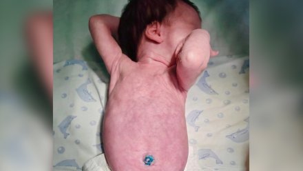 В Воронеже врачи провели операцию на кишечнике новорождённой девочки