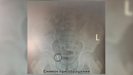 Воронежские медики удалили у ребёнка аппендикс из-за проглоченных магнитов