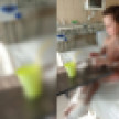 «Еле вытащили». Адвокат рассказал о состоянии девочки из Воронежа после отслоения кожи
