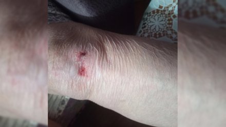 В Воронеже пенсионерка упала и поранила ноги из-за опасного бордюра на остановке