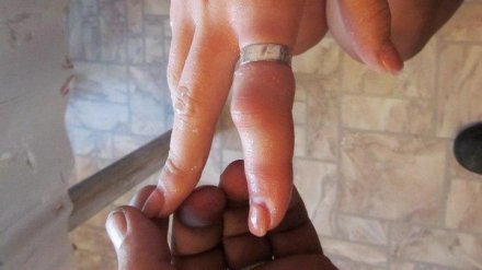 Спасатели помогли жительнице Воронежа снять кольцо с опухшего пальца
