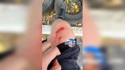 В воронежском ЖК подростка покусала сорвавшаяся с поводка такса