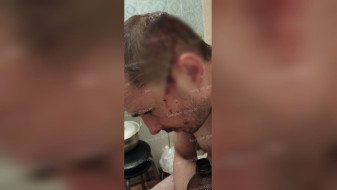 В Воронеже трое подростков разбили голову прохожему