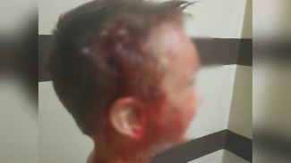 «Собака встала сверху». В Нововоронеже дворняга набросилась на ребёнка