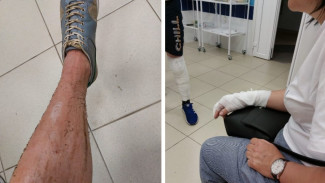 После сельского фаер-шоу ребёнка с ожогами отправили на лечение в Воронеж