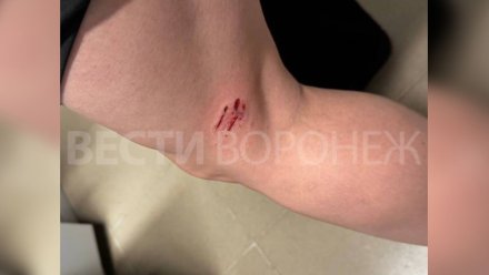 В Воронеже за неделю не смогли поймать собаку, покусавшую девушку