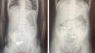 В Воронеже малыш проглотил 16 гаек