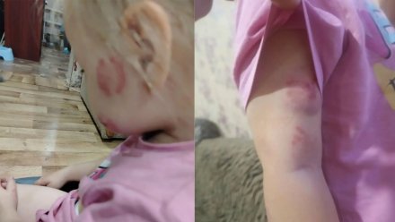 19 укусов нашли на теле 3-летней малышки в павловском детском садике