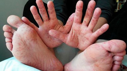 Число заболевших корью в Воронеже выросло до 16