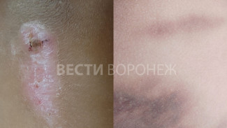 Воронежские врачи рассказали о состоянии избитого в школе четвероклассника