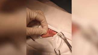 Воронежские врачи вырезали новообразование на ухе 15-летнего мальчика
