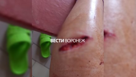 Бездомная собака напала на женщину и разорвала ей ногу в центре Воронежа