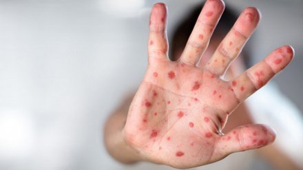 Врачи рассказали ещё о двух заболевших корью в Воронеже