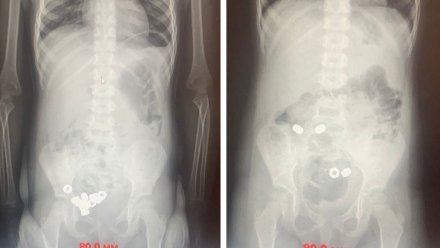 В Воронеже малыш проглотил 16 гаек