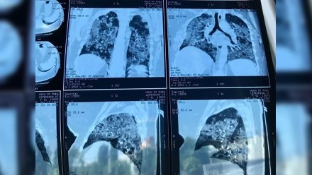 Воронежцам показали фото поражённых ковидом на 96% лёгких