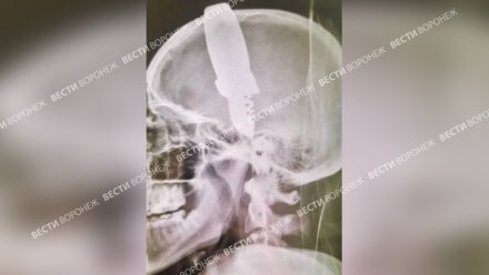 Раненного в голову ножом подростка спустя 2 недели выписали из воронежской больницы