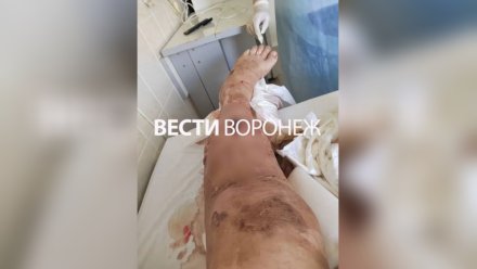 СК возбудил дело после ампутации ноги у рабочего предприятия в Лисках