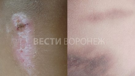 Воронежские врачи рассказали о состоянии избитого в школе четвероклассника