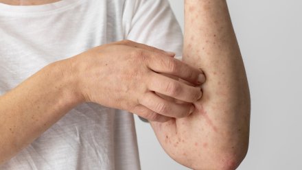 В Воронежской области резко возросла заболеваемость ветрянкой