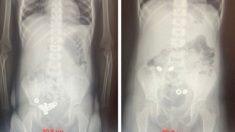 В Воронеже малыш проглотил 16 гаек