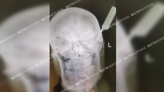 Нож в черепе воронежского школьника показали на снимке