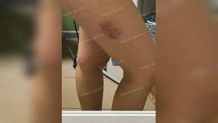 Девушка получила травму после нападения стаи собак в Воронеже