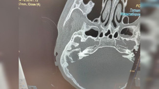 Воронежские врачи прооперировали 17-летнего парня с гноящимся наростом в ухе